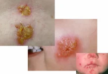 Impetigo: bolezen, ki je vse pogostejša pri otrocih.